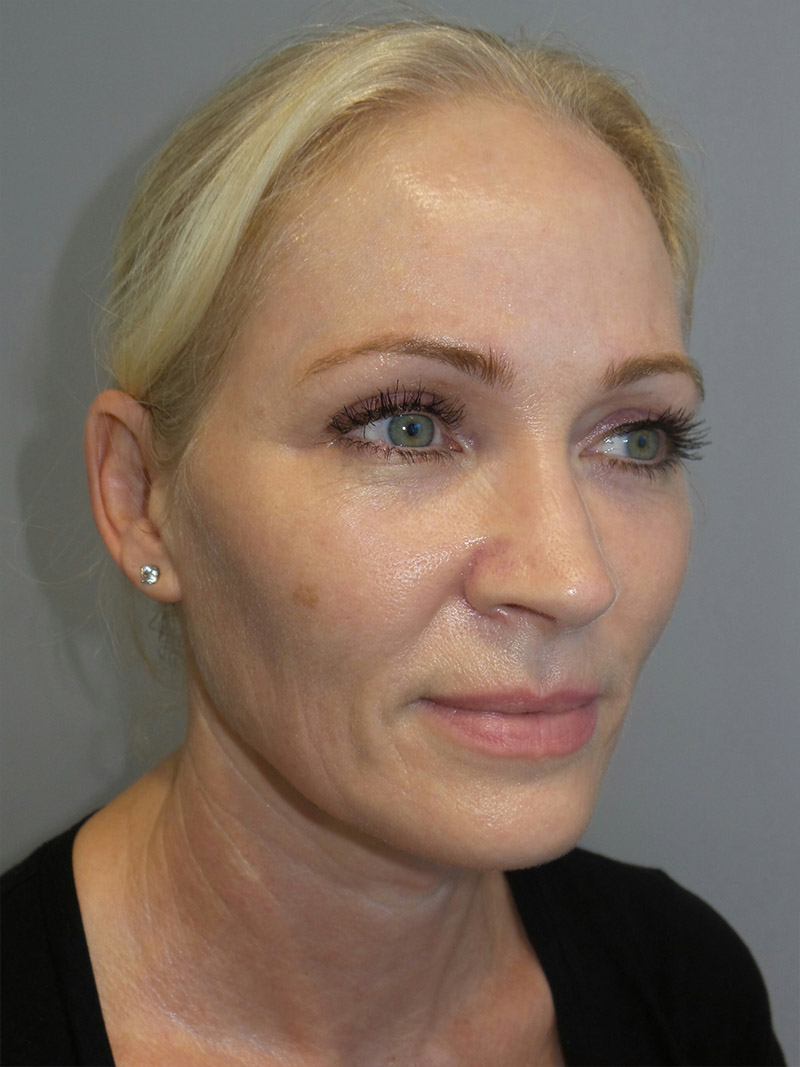 Facelift Before and After 34 | Sanjay Grover MD FACS