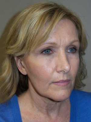 Facelift Before and After 35 | Sanjay Grover MD FACS