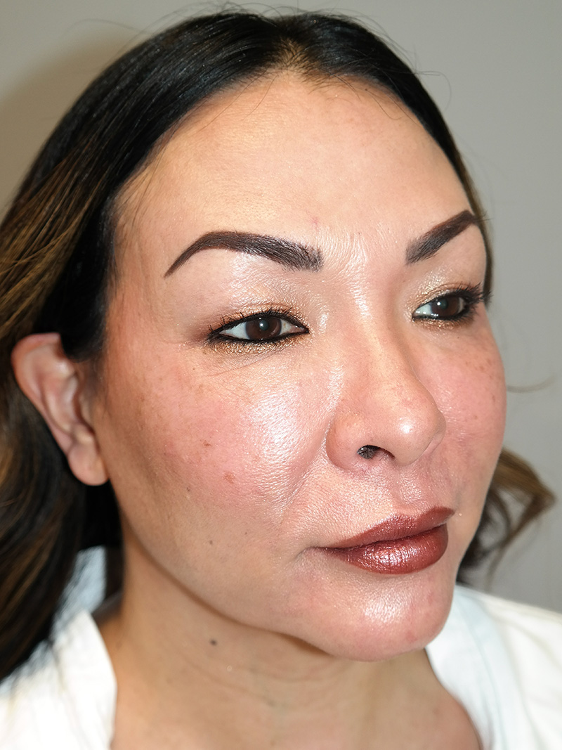 Facelift Before and After 31 | Sanjay Grover MD FACS