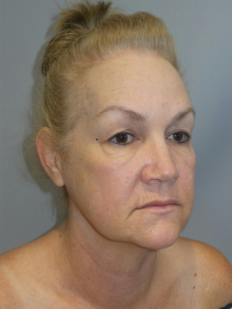 Facelift Before and After 36 | Sanjay Grover MD FACS