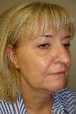 Facelift Before and After 28 | Sanjay Grover MD FACS