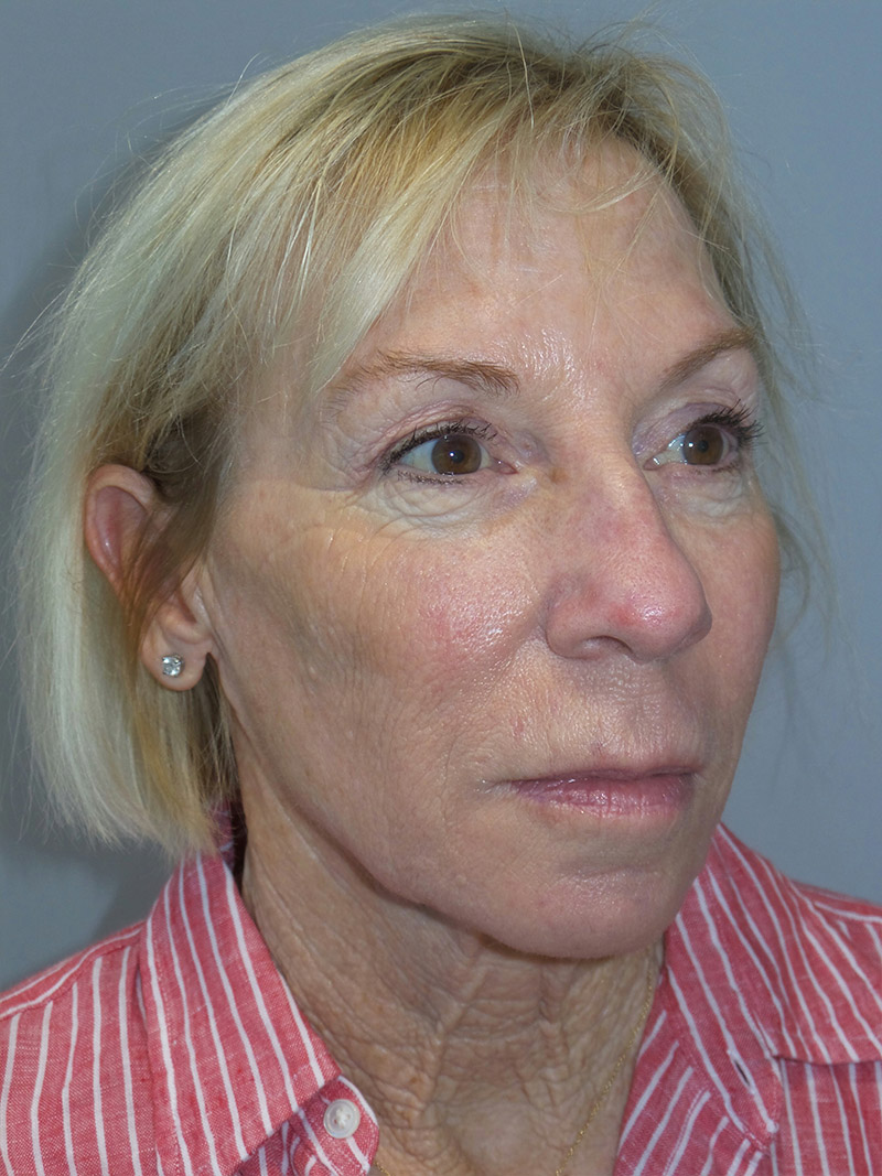 Facelift Before and After | Sanjay Grover MD FACS