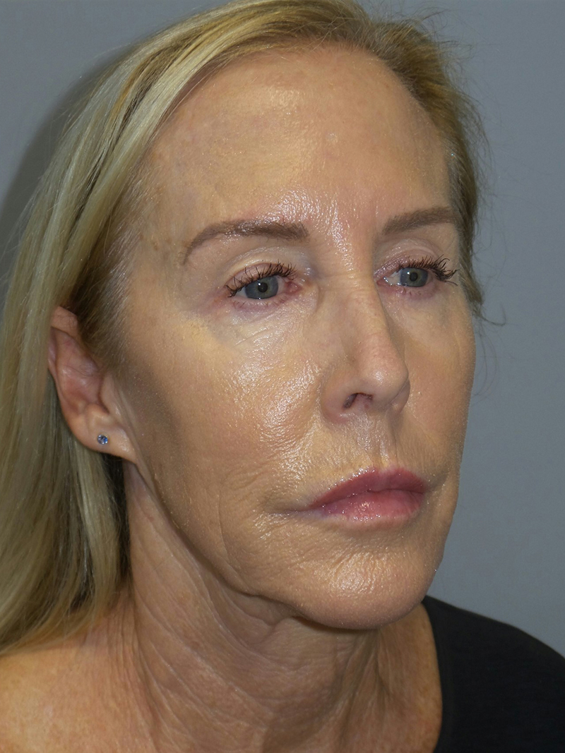 Facelift Before and After 23 | Sanjay Grover MD FACS