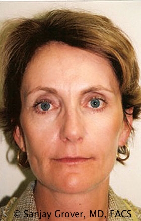Facelift Before and After 36 | Sanjay Grover MD FACS