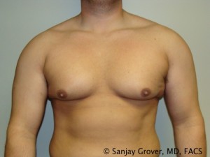 Gynecomastia Before and After 15 | Sanjay Grover MD FACS