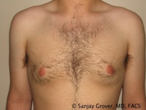 Gynecomastia Before and After 04 | Sanjay Grover MD FACS