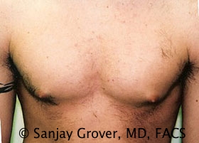 Gynecomastia Before and After 12 | Sanjay Grover MD FACS