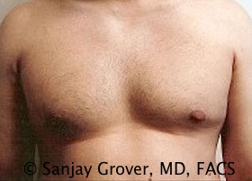 Gynecomastia Before and After 18 | Sanjay Grover MD FACS