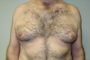 Gynecomastia Before and After | Sanjay Grover MD FACS