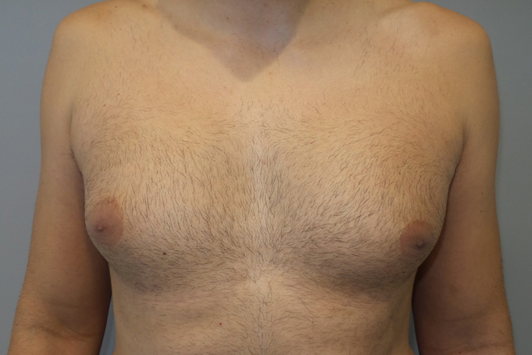 Gynecomastia Before and After 23 | Sanjay Grover MD FACS