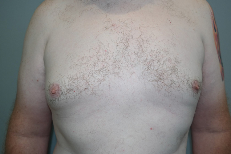 Gynecomastia Before and After 23 | Sanjay Grover MD FACS