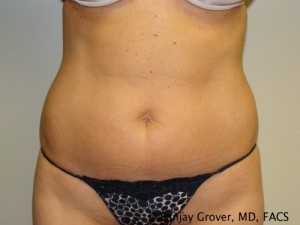 Velashape Before and After 02 | Sanjay Grover MD FACS