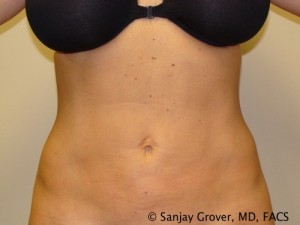 Velashape Before and After | Sanjay Grover MD FACS