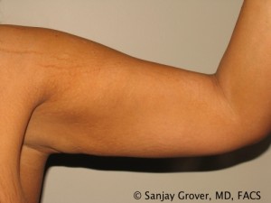 Arm Lift Before and After 05 | Sanjay Grover MD FACS