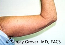 Arm Lift Before and After 07 | Sanjay Grover MD FACS