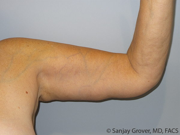 Arm Lift Before and After 08 | Sanjay Grover MD FACS