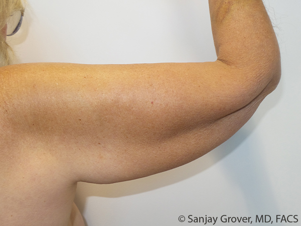 Arm Lift Before and After 08 | Sanjay Grover MD FACS