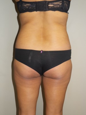 Butt Augmentation Before and After | Sanjay Grover MD FACS