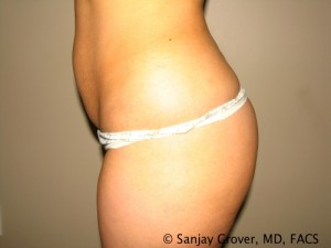 Butt Augmentation Before and After 03 | Sanjay Grover MD FACS