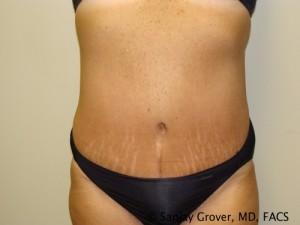 Diastasis Recti Before and After | Sanjay Grover MD FACS
