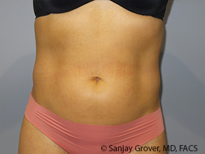 Liposuction Before and After 06 | Sanjay Grover MD FACS