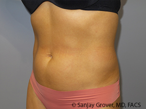 Liposuction Before and After 03 | Sanjay Grover MD FACS