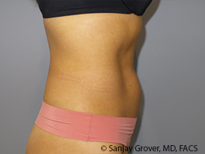 Liposuction Before and After 03 | Sanjay Grover MD FACS