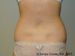 Liposuction Before and After 04 | Sanjay Grover MD FACS