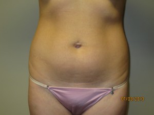 Liposuction Before and After 02 | Sanjay Grover MD FACS