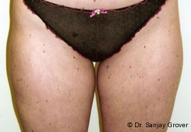 Liposuction Before and After 20 | Sanjay Grover MD FACS