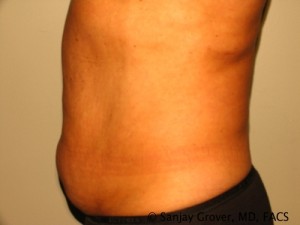 Liposuction Before and After 18 | Sanjay Grover MD FACS