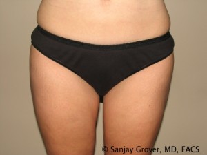 Liposuction Before and After | Sanjay Grover MD FACS