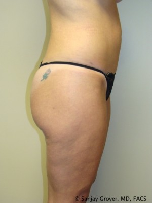 Liposuction Before and After 22 | Sanjay Grover MD FACS