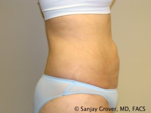 Liposuction Before and After 23 | Sanjay Grover MD FACS