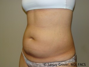 Liposuction Before and After 23 | Sanjay Grover MD FACS