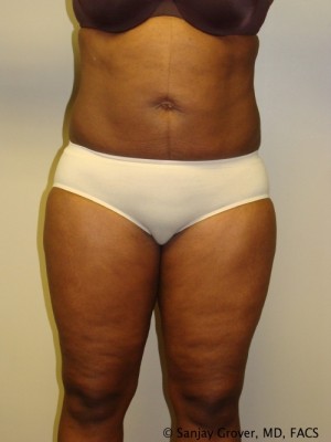Liposuction Before and After | Sanjay Grover MD FACS