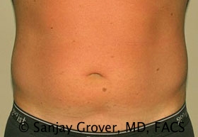 Liposuction Before and After 26 | Sanjay Grover MD FACS