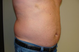 Liposuction Before and After 38 | Sanjay Grover MD FACS