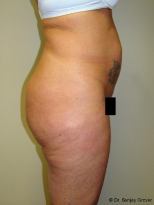 Liposuction Before and After 39 | Sanjay Grover MD FACS