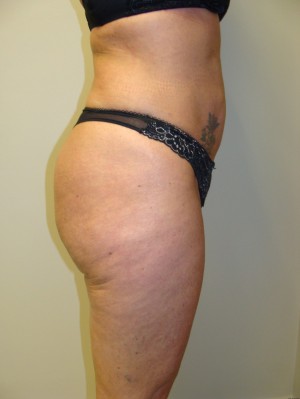 Liposuction Before and After 39 | Sanjay Grover MD FACS