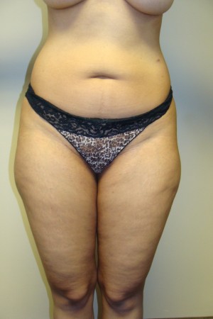 Liposuction Before and After 25 | Sanjay Grover MD FACS