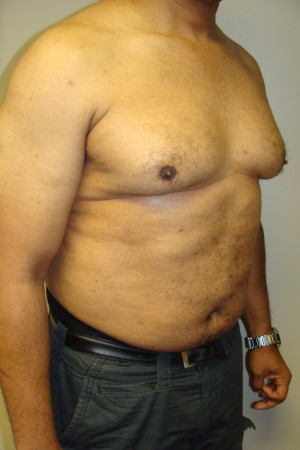 Liposuction Before and After 44 | Sanjay Grover MD FACS