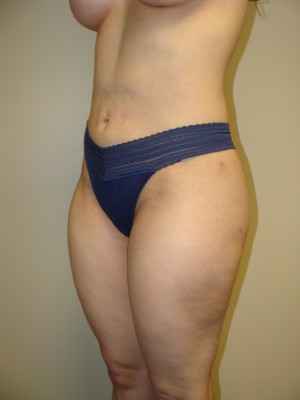 Liposuction Before and After 47 | Sanjay Grover MD FACS