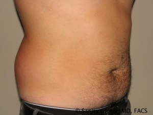 Liposuction Before and After 08 | Sanjay Grover MD FACS