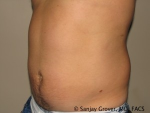 Liposuction Before and After 56 | Sanjay Grover MD FACS