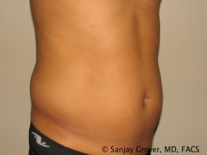 Liposuction Before and After 40 | Sanjay Grover MD FACS