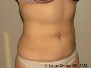 Liposuction Before and After 60 | Sanjay Grover MD FACS