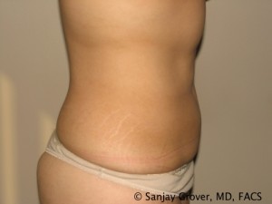 Liposuction Before and After 60 | Sanjay Grover MD FACS