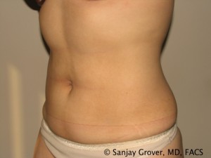 Liposuction Before and After 60 | Sanjay Grover MD FACS