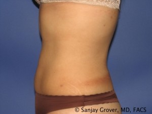 Liposuction Before and After 60 | Sanjay Grover MD FACS